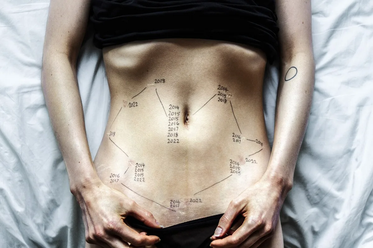 Small scars on a womans stomach from endometriosis operations, with the dates or the surgeries next to them. 